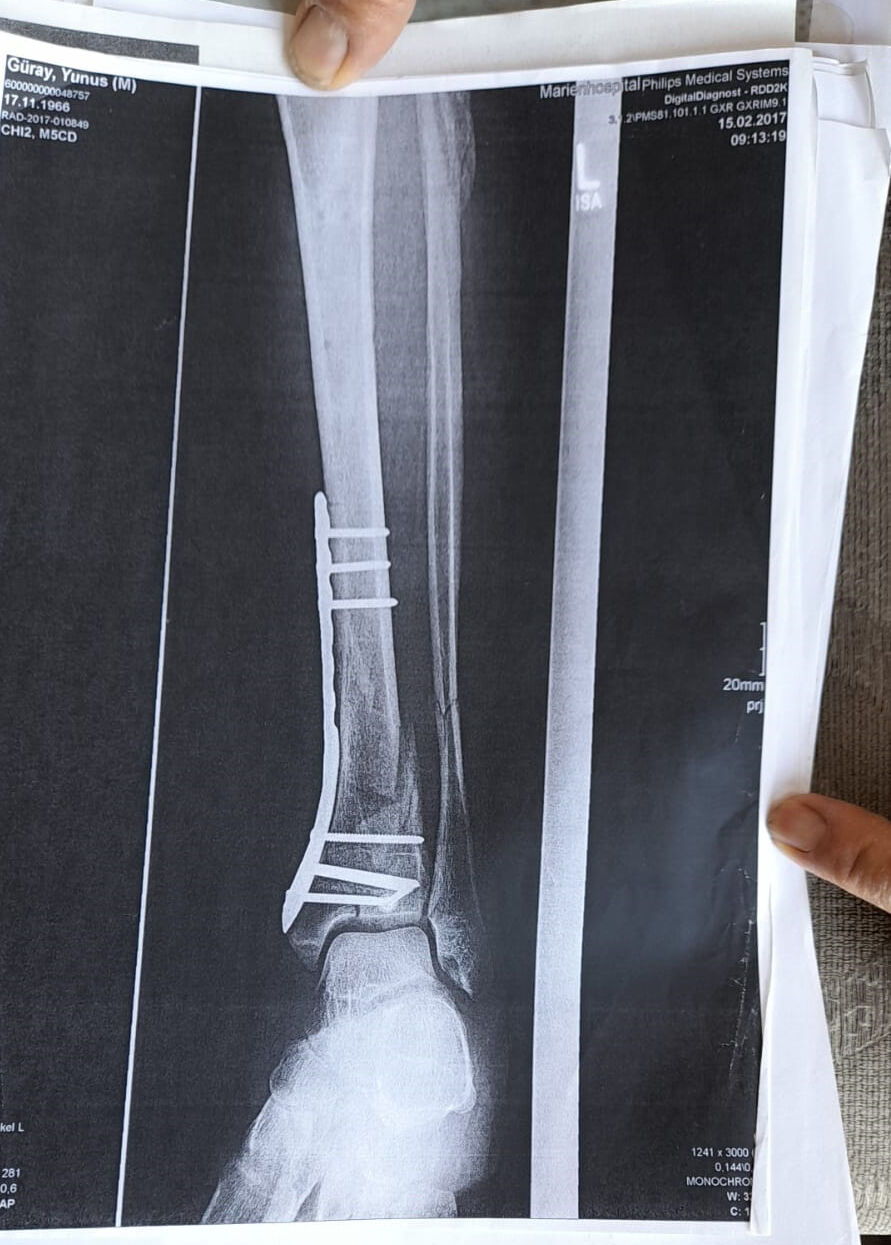 Arkeolojik Kazi Alanindaki Cukura Dustu4