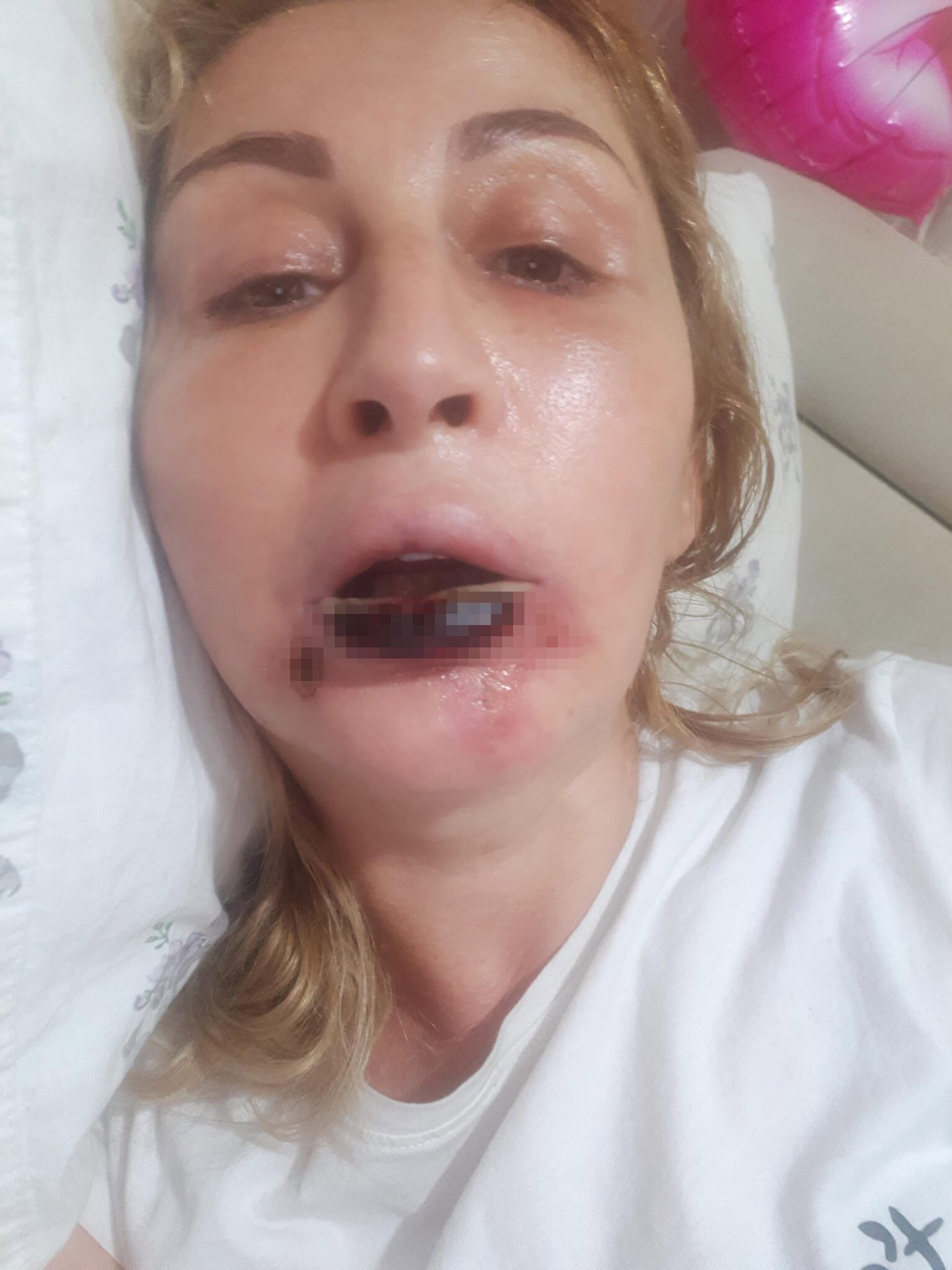 Antalya Estetik Dudagi Curudu2