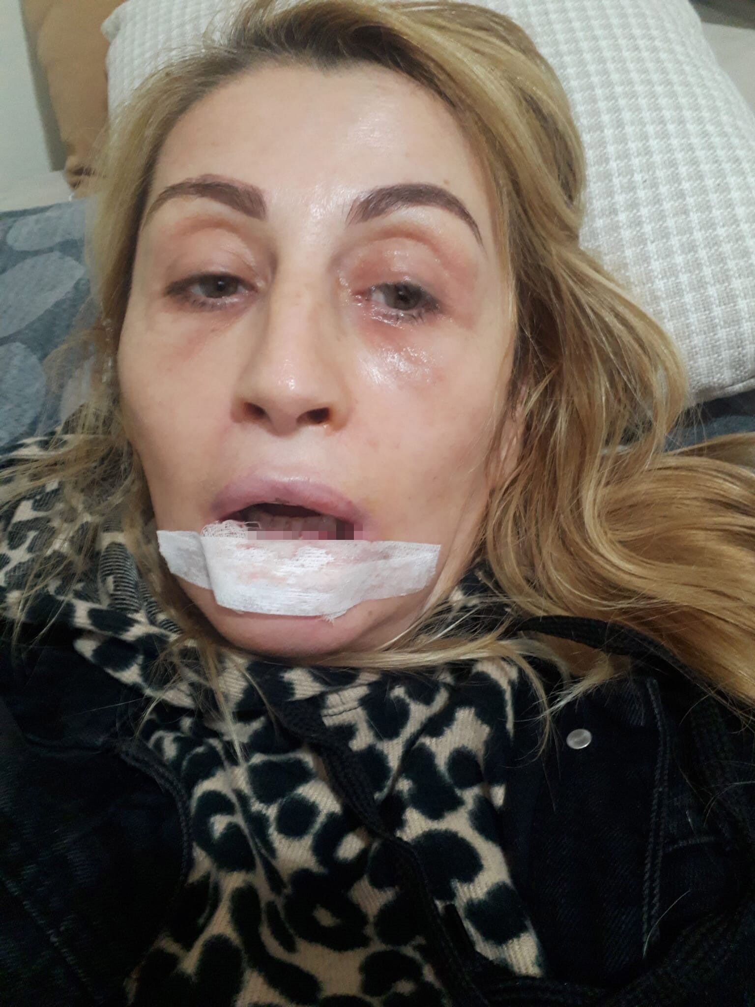 Antalya Estetik Dudagi Curudu3
