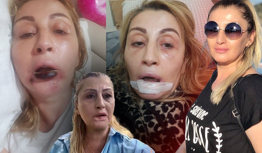 Antalya'da estetik işlem sonrası dudağı çürüdü: "Benim hakkımı kim arayacak?" diyerek isyan etti!